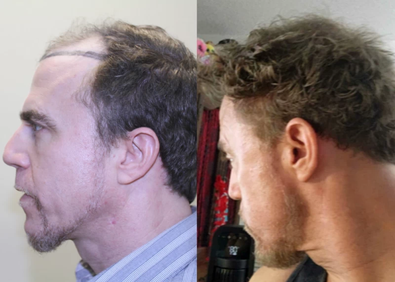 Patient p581 hair transplant before and after left view