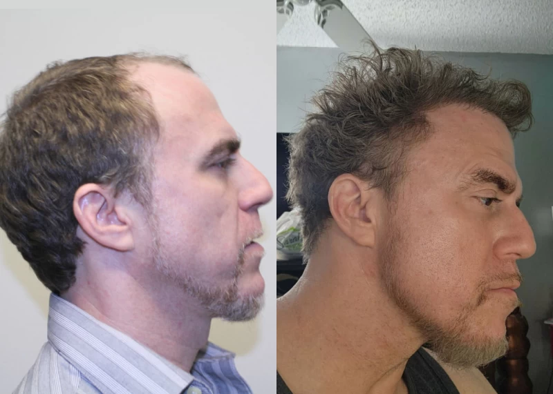 Patient p581 hair transplant before and after right view