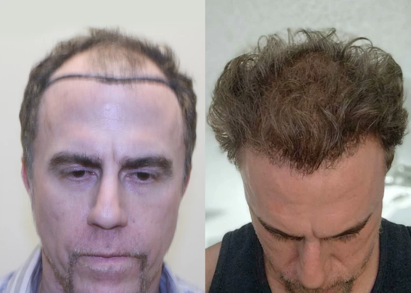 Patient p581 hair transplant before and after tilt view