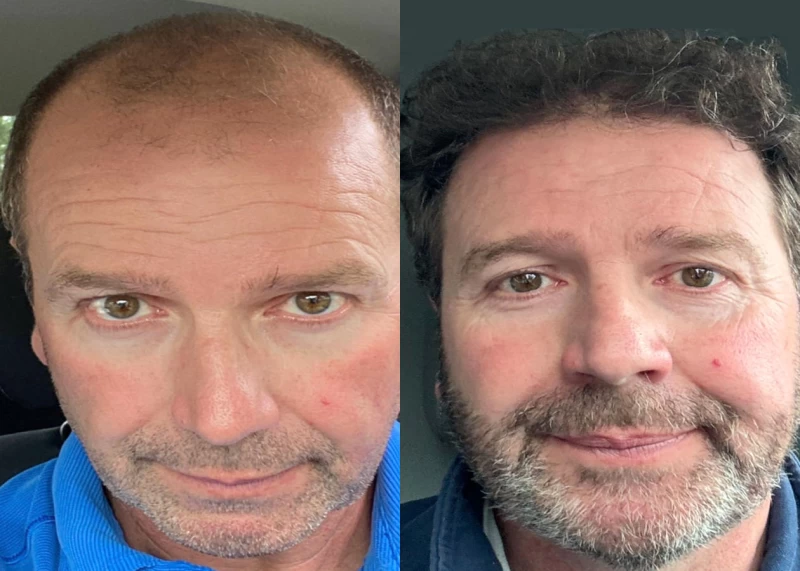Patient 582 Hair Transplant Before and After