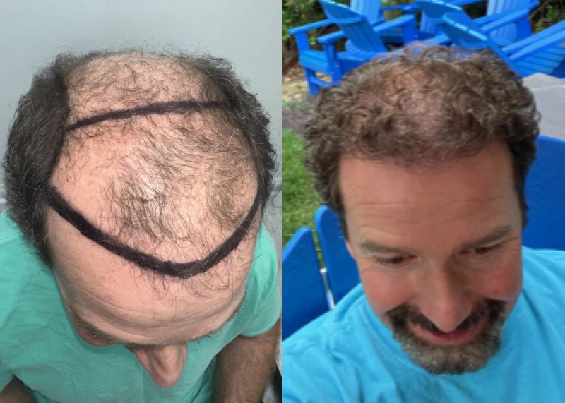 Patient p582 hair transplant before and after tilt view