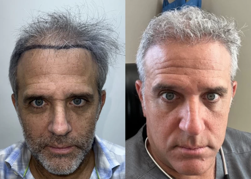 Patient 583 Hair Transplant Before and After