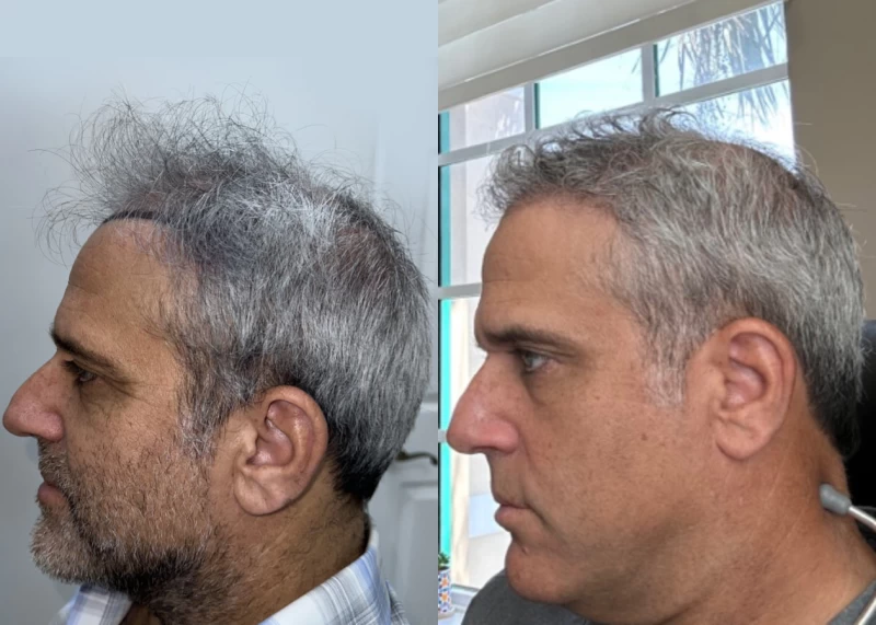 Patient p583 hair transplant before and after left view
