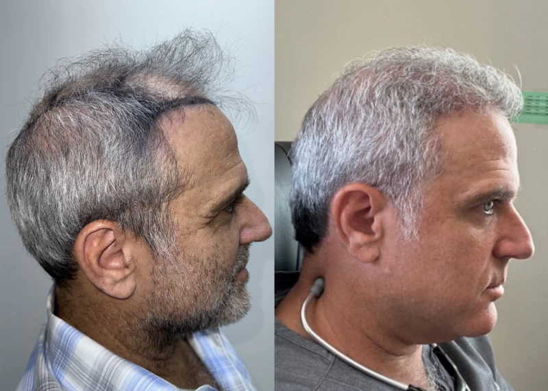 Patient p583 hair transplant before and after right view