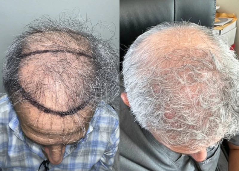 Patient p583 hair transplant before and after tilt view