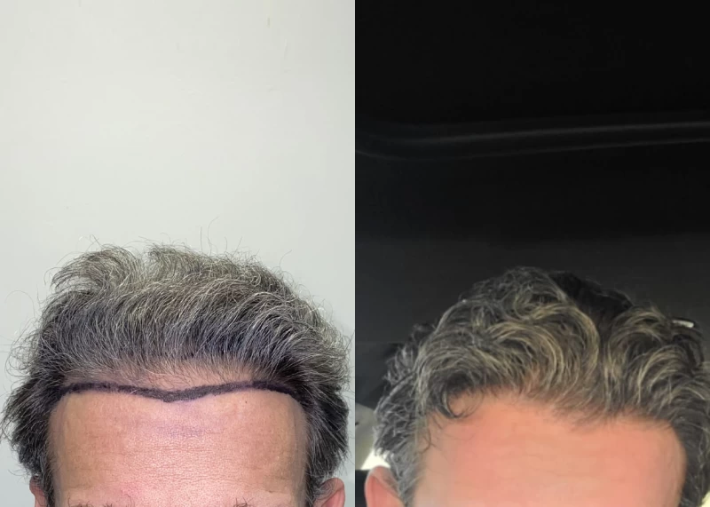 Patient 584 Hair Transplant Before and After