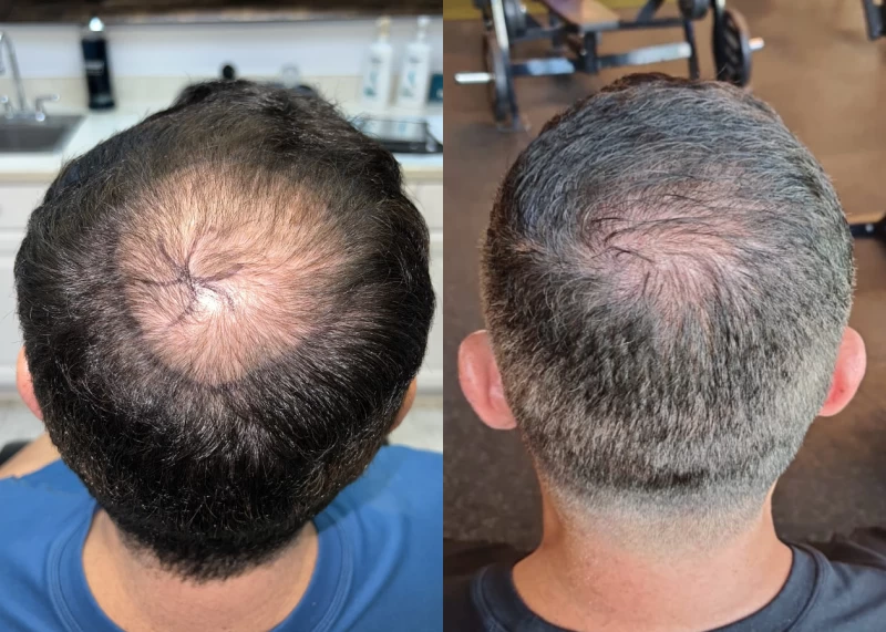 Patient 585 Hair Transplant Before and After