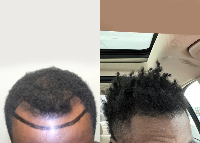 Patient 586 Hair Transplant Before and After