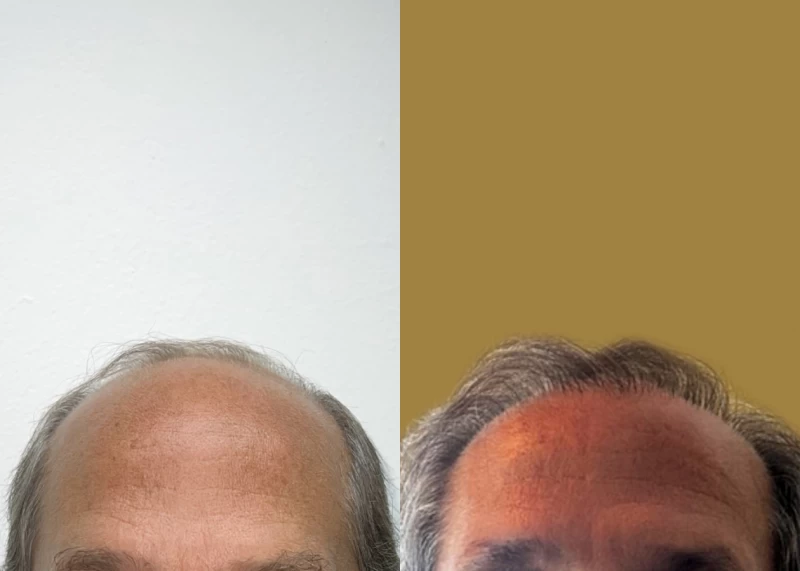 Patient 587 Hair Transplant Before and After