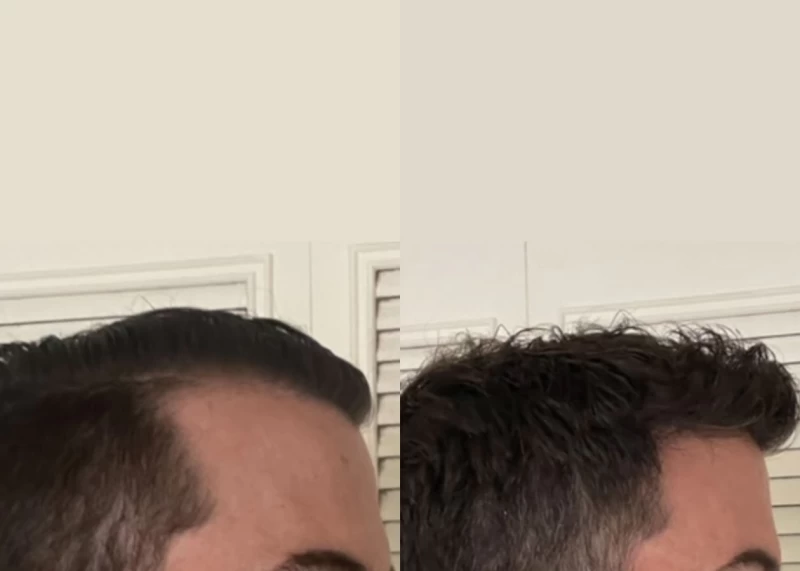 Patient 588 Hair Transplant Before and After