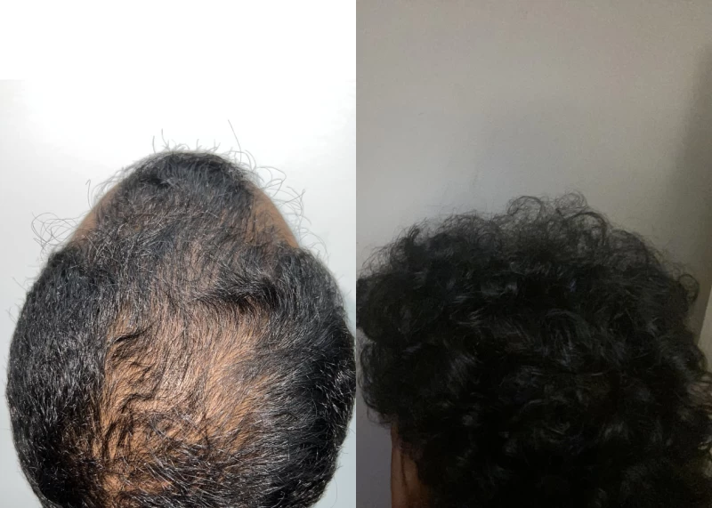 Patient p589 hair transplant before and after crown view