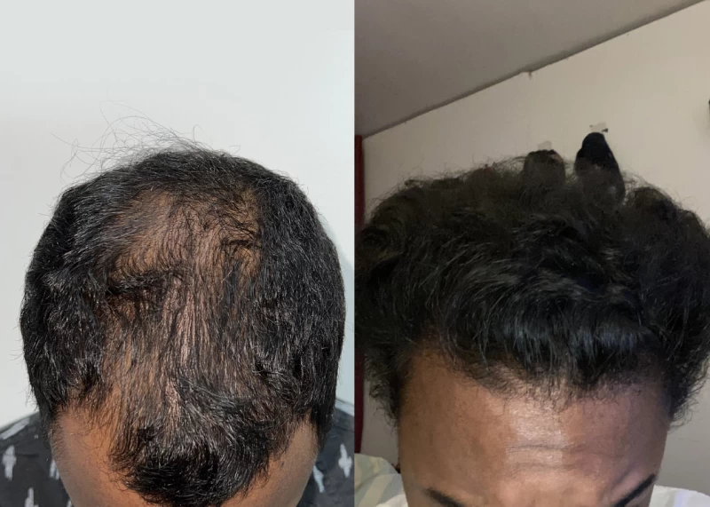 Patient 589 Hair Transplant Before and After