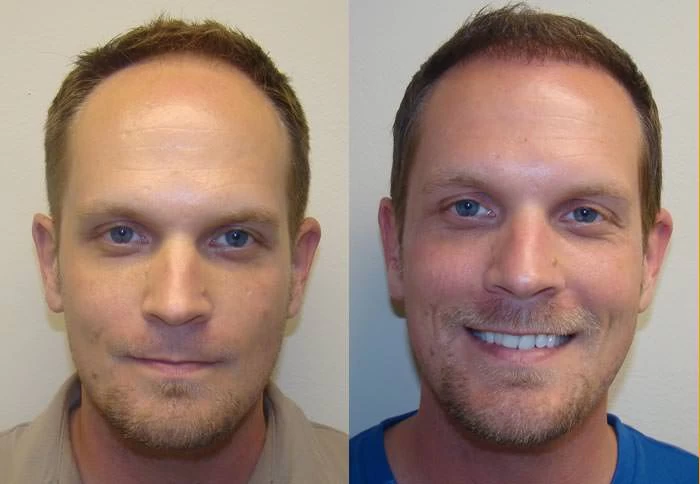 Brian Hair Transplant Before and After