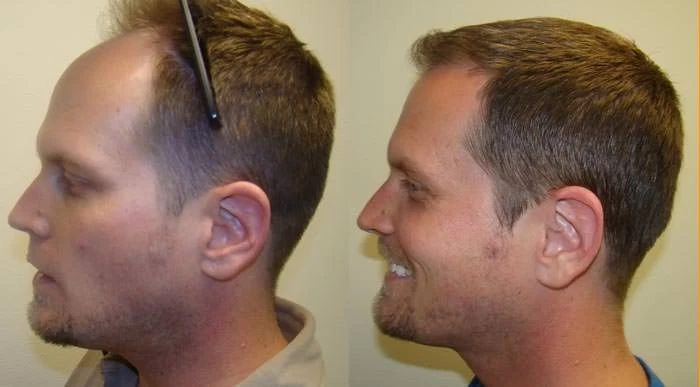 Patient p58 hair transplant before and after left view