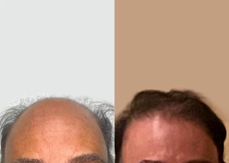 Patient 590 Hair Transplant Before and After
