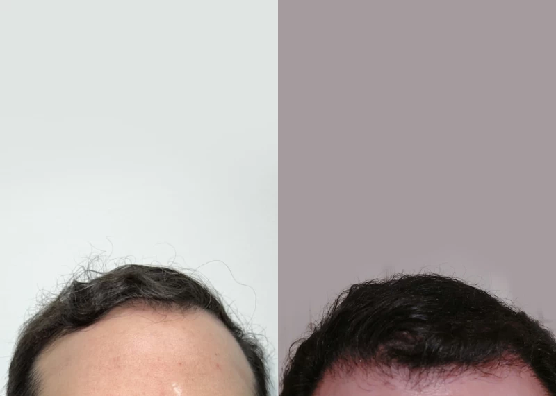 Patient 591 Hair Transplant Before and After