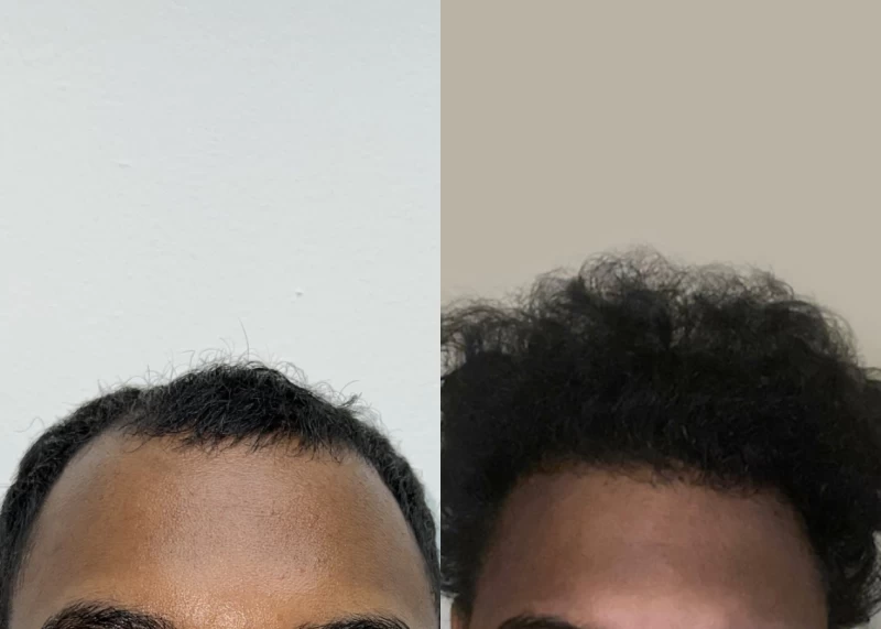 Patient 592 Hair Transplant Before and After