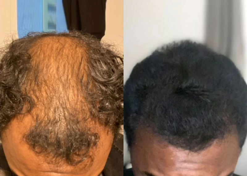 Patient p592 hair transplant before and after tilt view