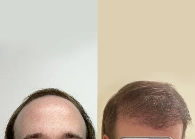 Patient 593 Hair Transplant Before and After