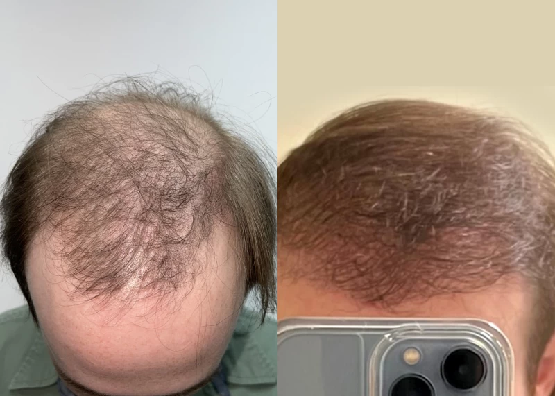 Patient p593 hair transplant before and after tilt view