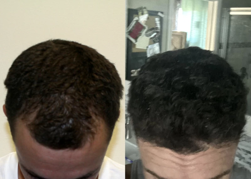 Patient 594 Hair Transplant Before and After