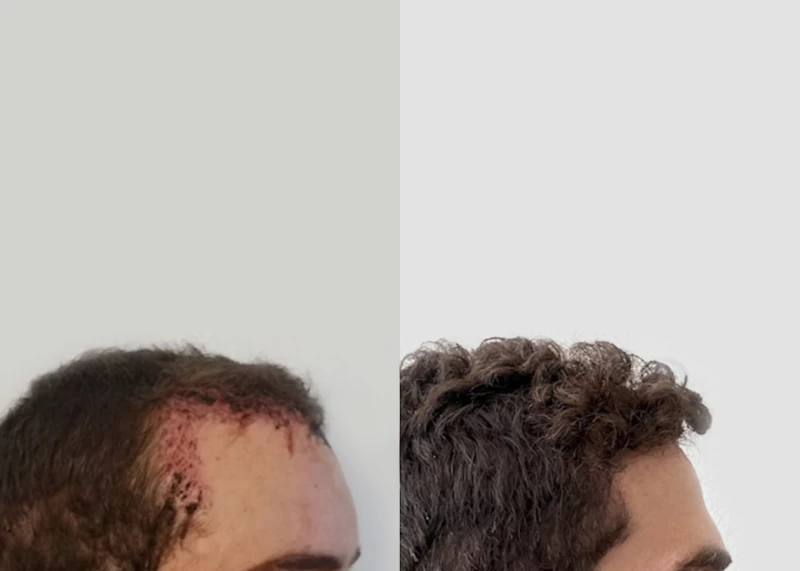 Patient 595 Hair Transplant Before and After