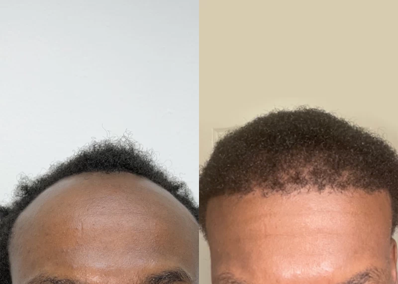 Patient 596 Hair Transplant Before and After