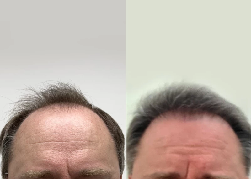 Patient 597 Hair Transplant Before and After