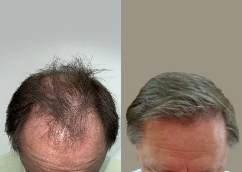 Patient p597 hair transplant before and after tilt view