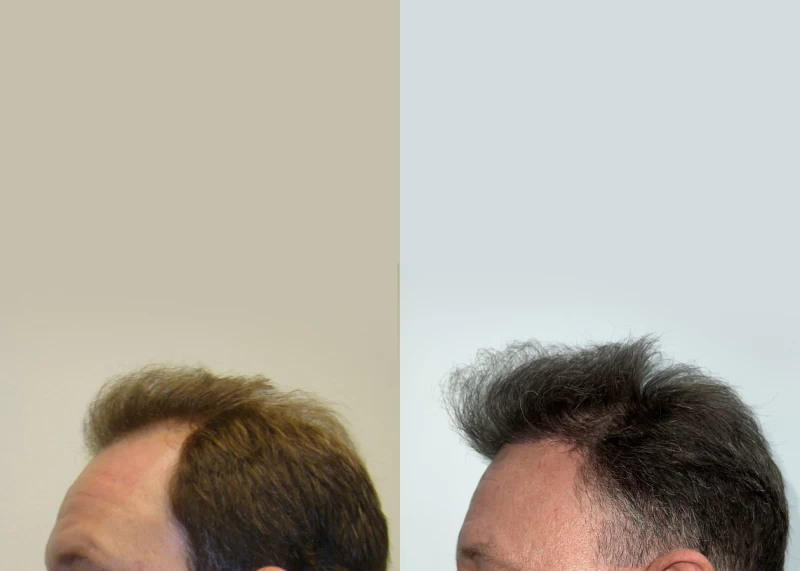 Patient p598 hair transplant before and after left view