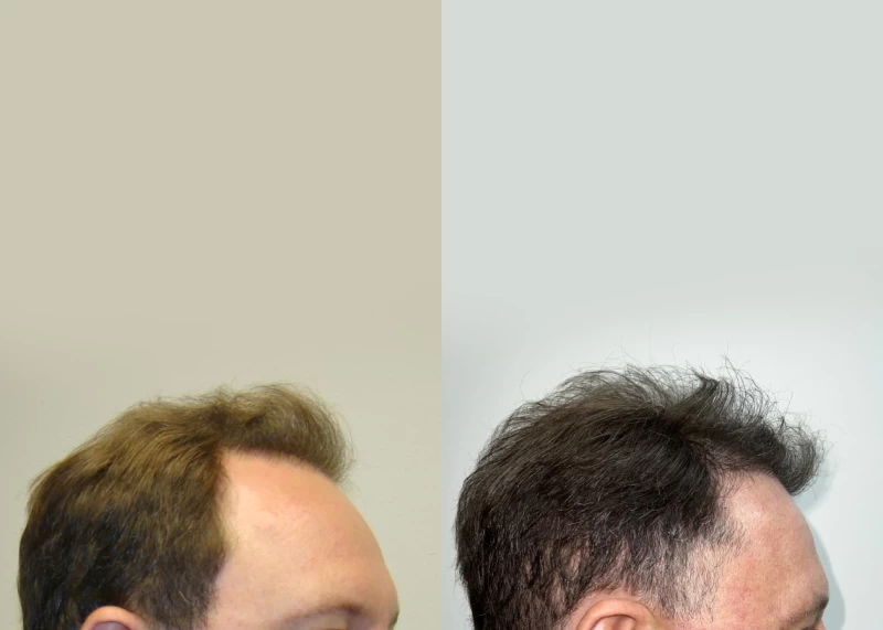 Patient p598 hair transplant before and after right view