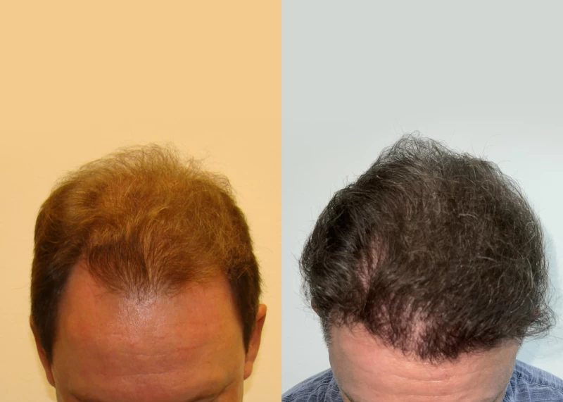 Patient 598 Hair Transplant Before and After