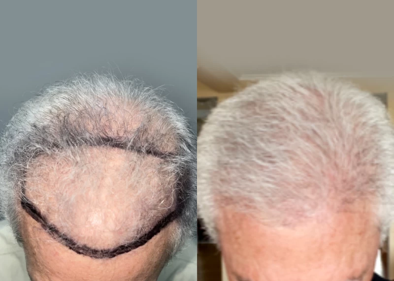 Patient 599 Hair Transplant Before and After