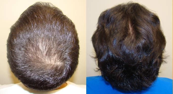 Patient p59 hair transplant before and after crown view