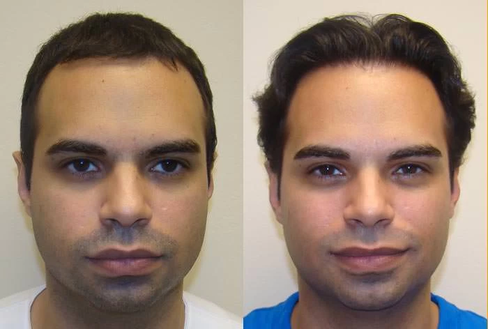 Esteban Hair Transplant Before and After