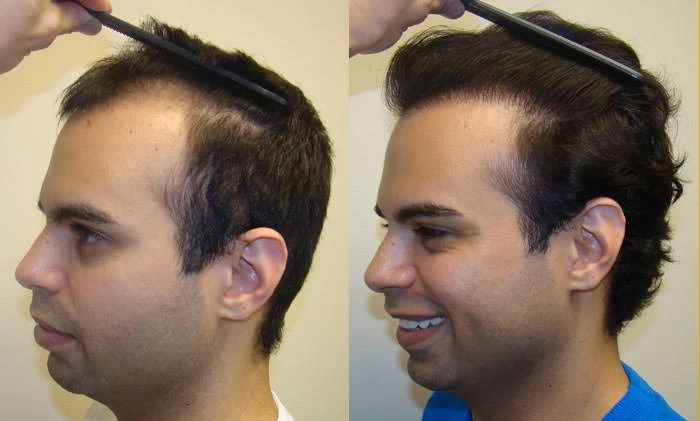 Patient p59 hair transplant before and after left view