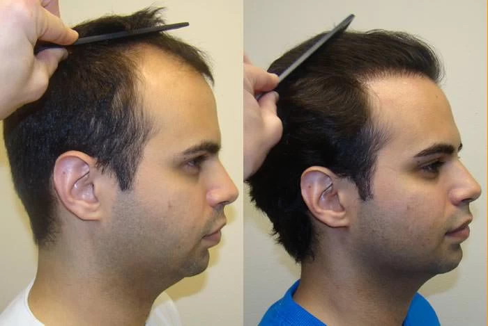 Patient p59 hair transplant before and after right view