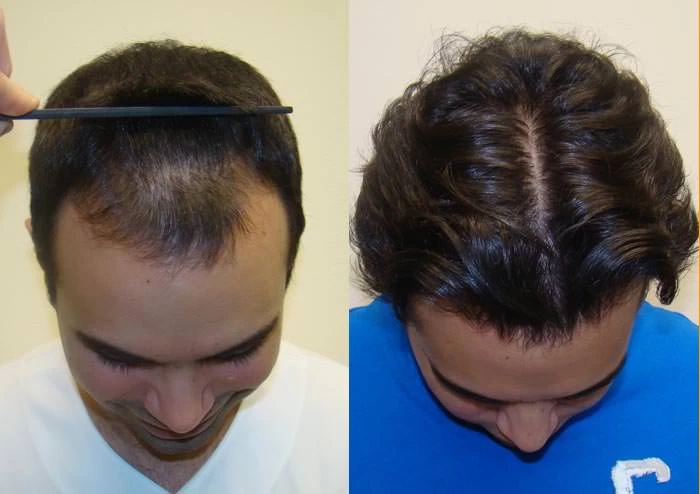 Patient p59 hair transplant before and after tilt view