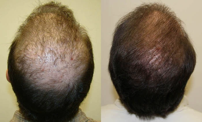 Patient p5 hair transplant before and after crown view