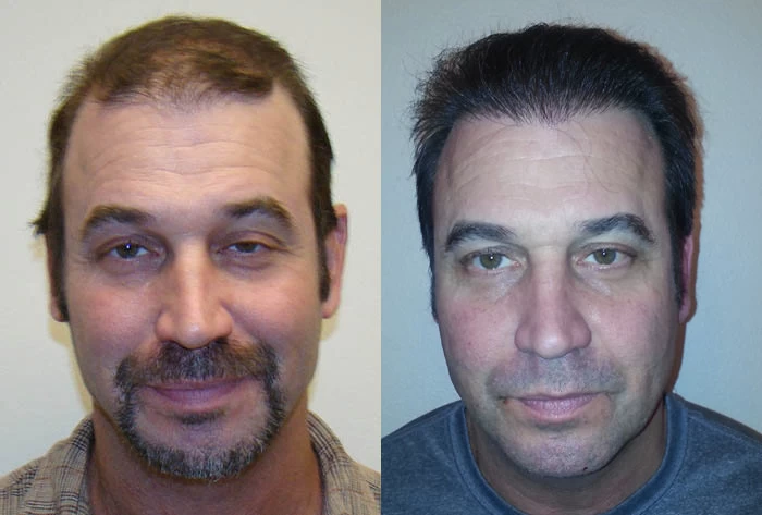 Marc Hair Transplant Before and After