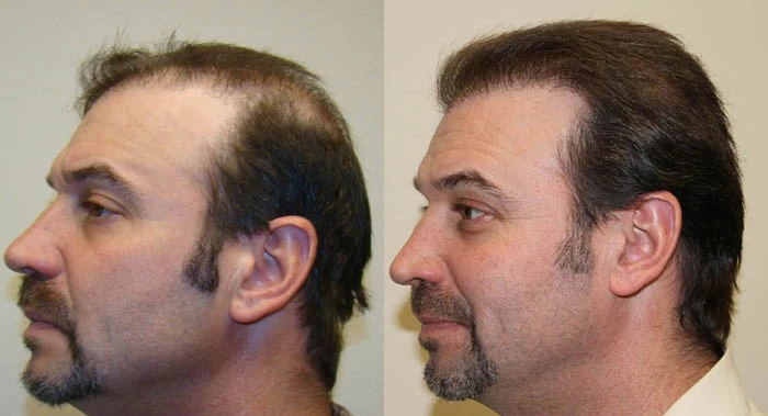 Patient p5 hair transplant before and after left view