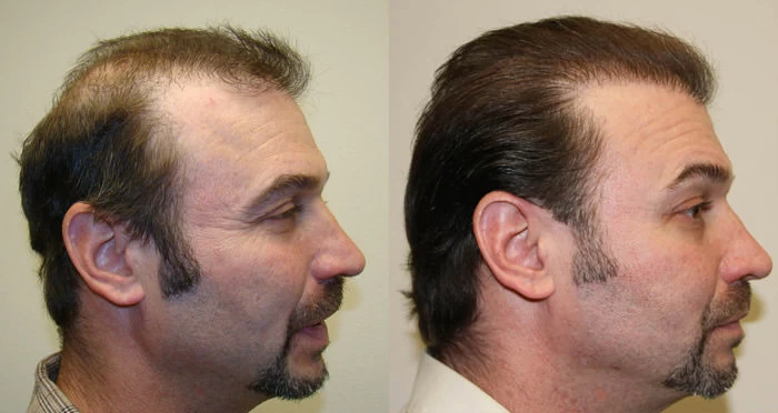 Patient p5 hair transplant before and after right view