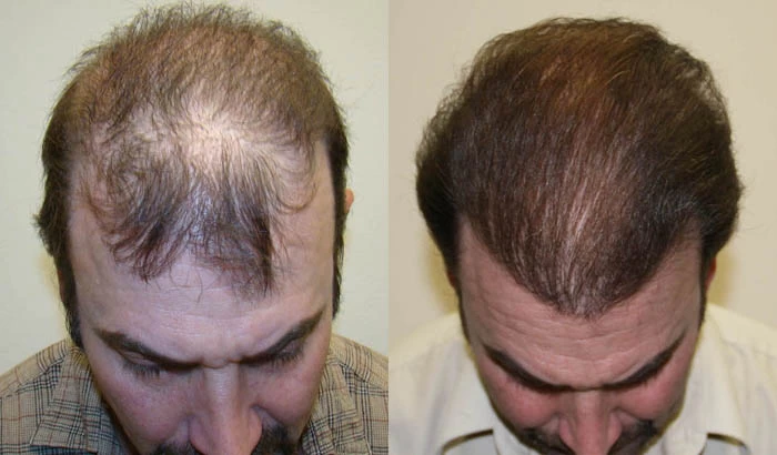 Patient p5 hair transplant before and after tilt view