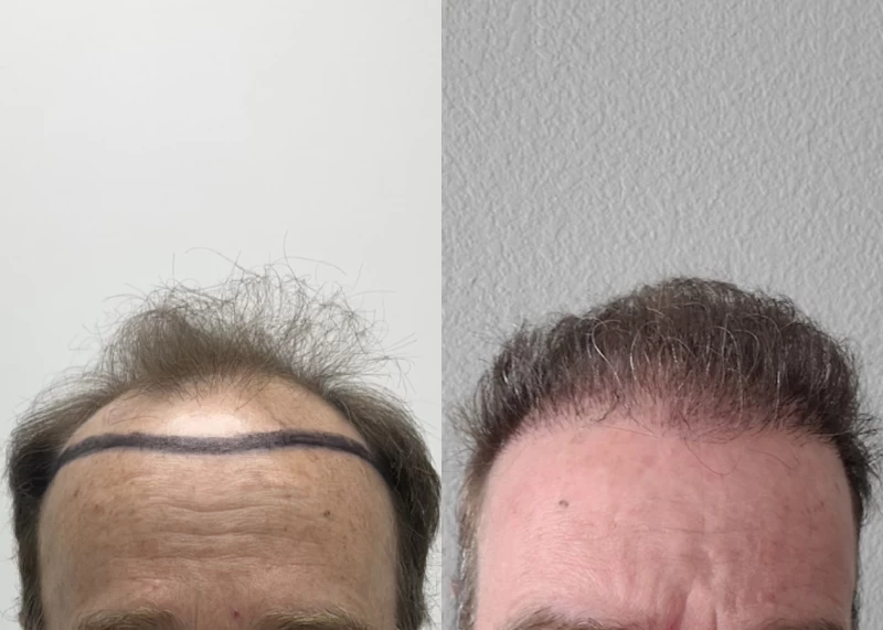 Patient 600 Hair Transplant Before and After
