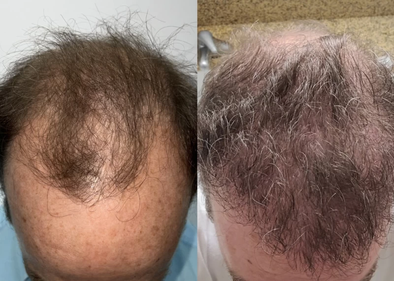 Patient p600 hair transplant before and after tilt view