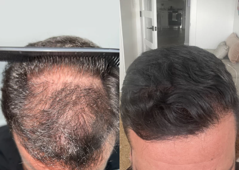 Patient 601 Hair Transplant Before and After