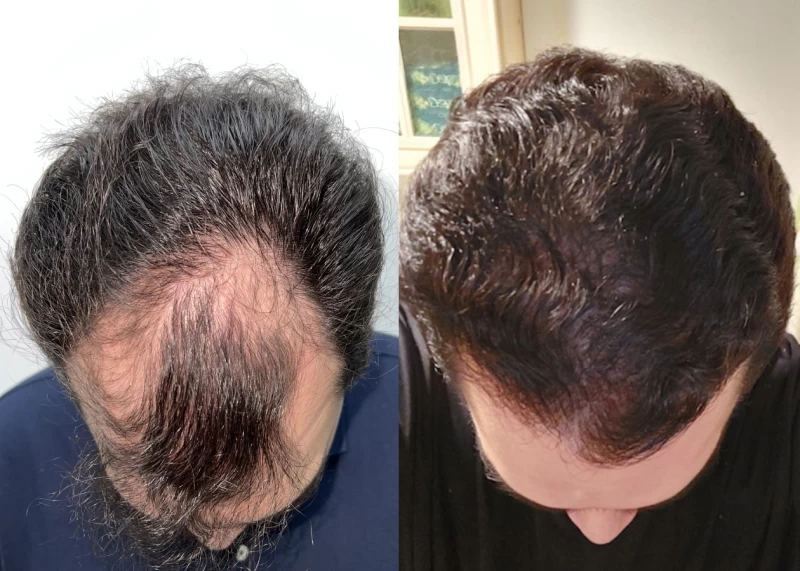 Patient 602 Hair Transplant Before and After