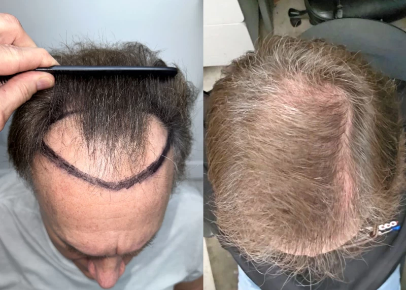 Patient 603 Hair Transplant Before and After
