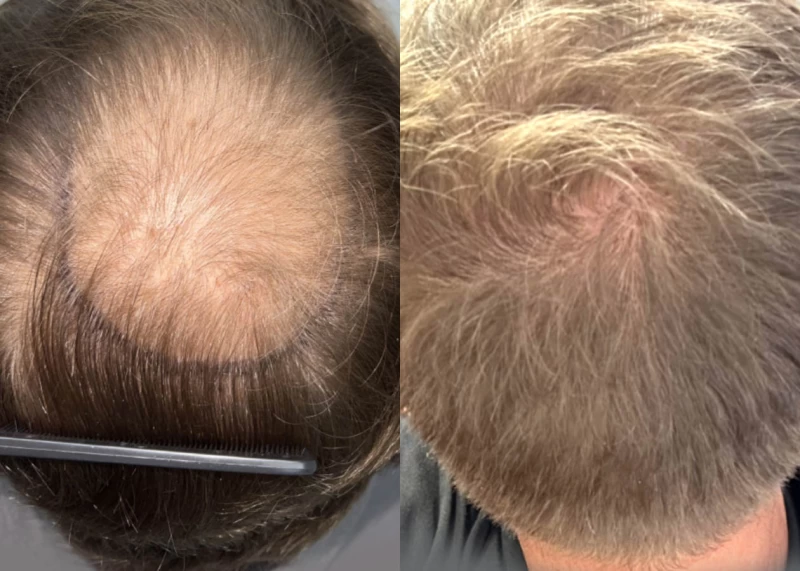 Patient 604 Hair Transplant Before and After