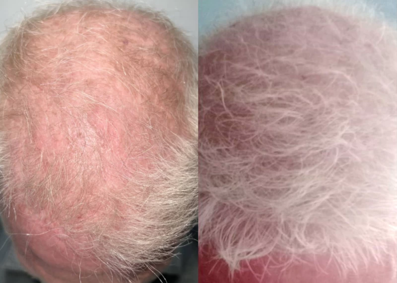 Patient 605 Hair Transplant Before and After